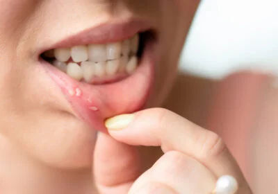 close-up-lip-with-aphthous-stomatitis